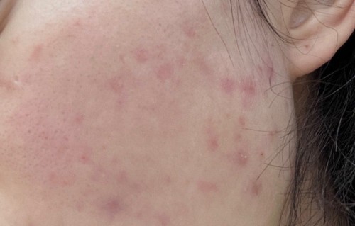 悟空祛痘靠谱吗，深度测评