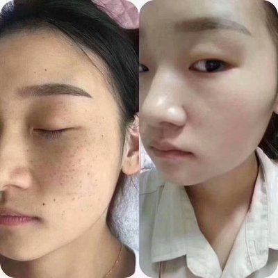 有效祛斑(有效祛斑用什么)