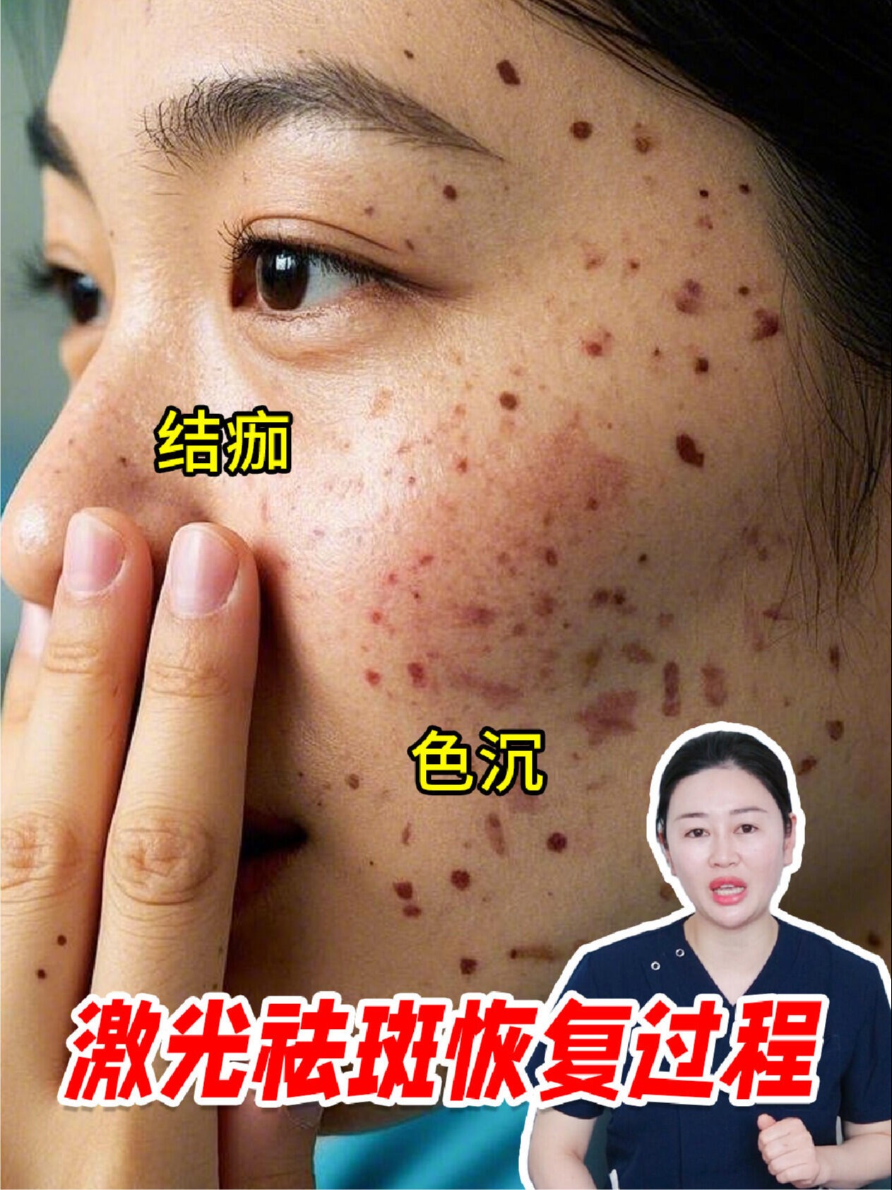 祛除祛斑(红霉素软膏能去脸上的斑吗)