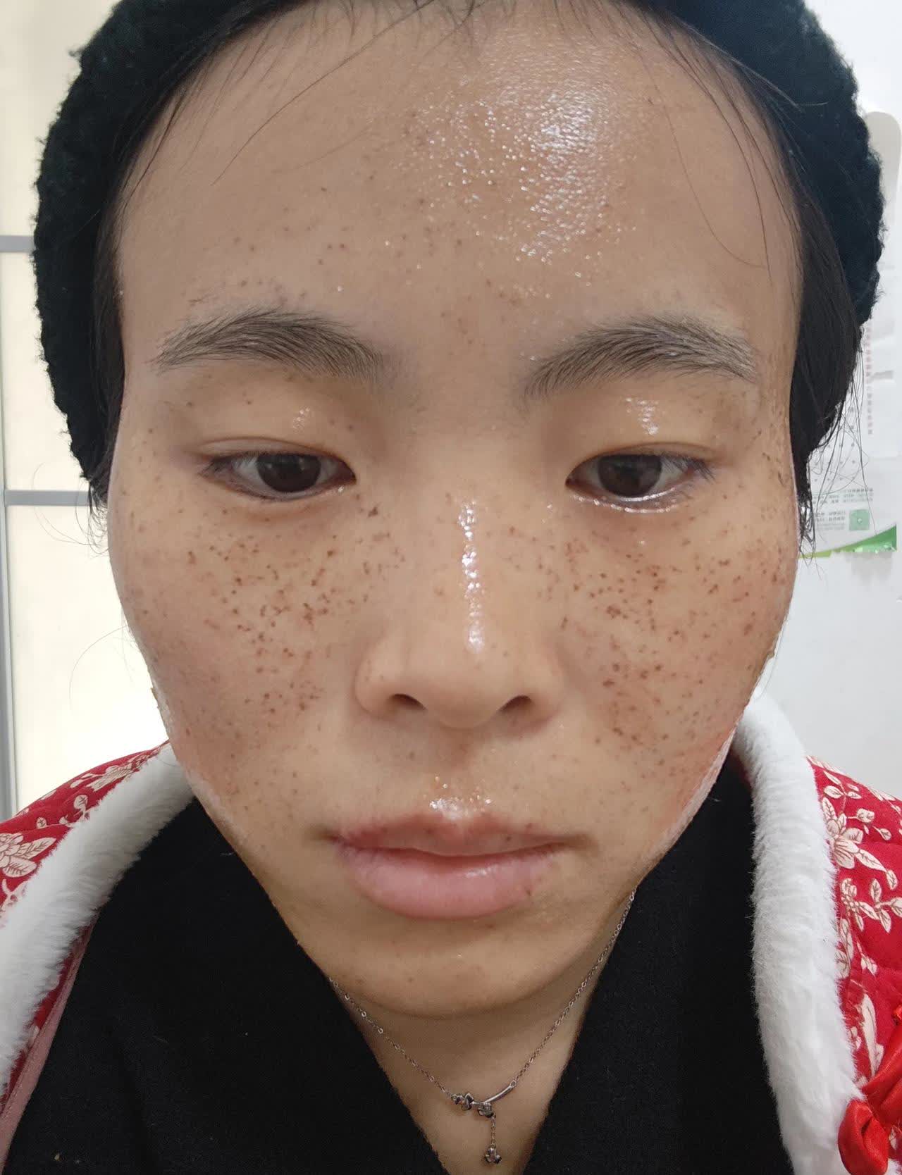 激光祛斑(激光祛斑后的保养和注意事项)