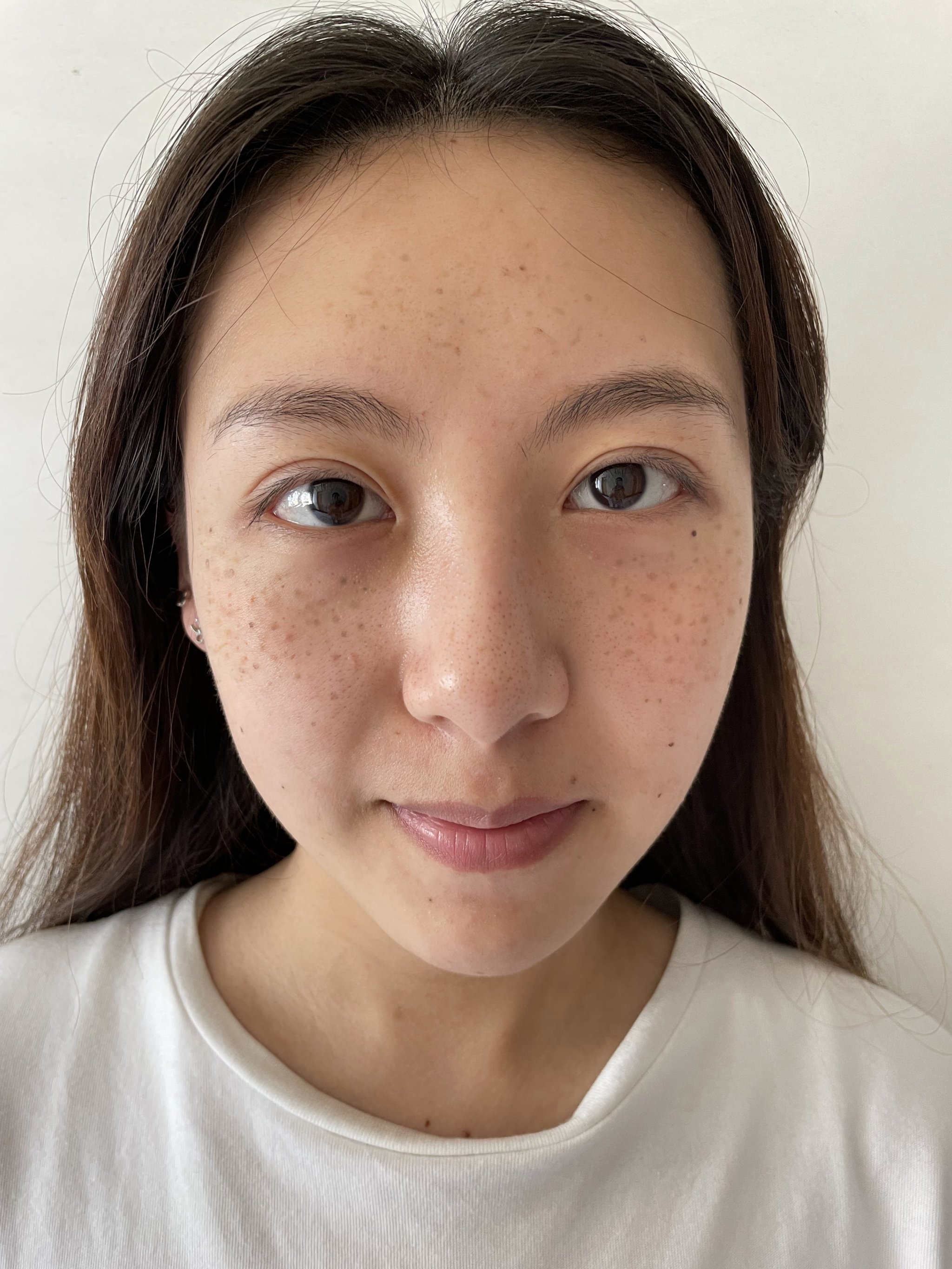 激光祛斑疼吗(激光祛斑一次能干净吗)