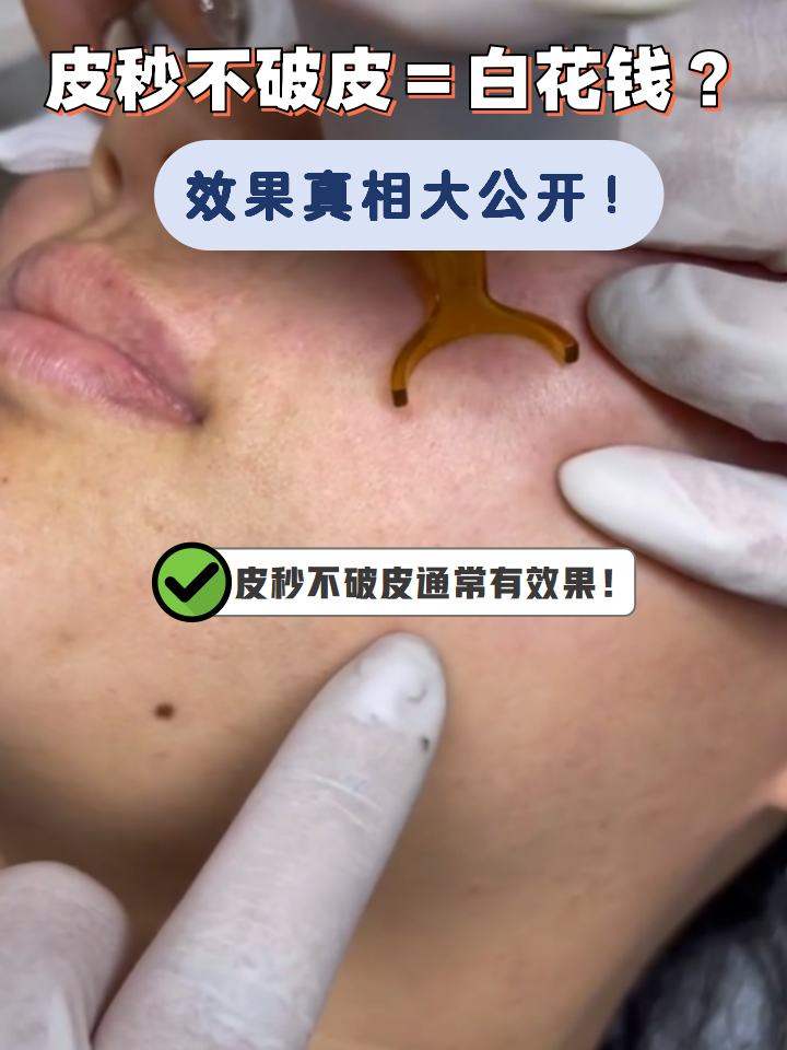 激光祛斑有什么危害(激光祛斑对身体有影响吗)