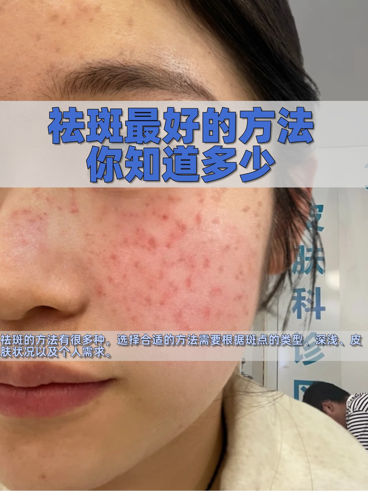 祛痘祛斑(祛痘祛斑印激光)