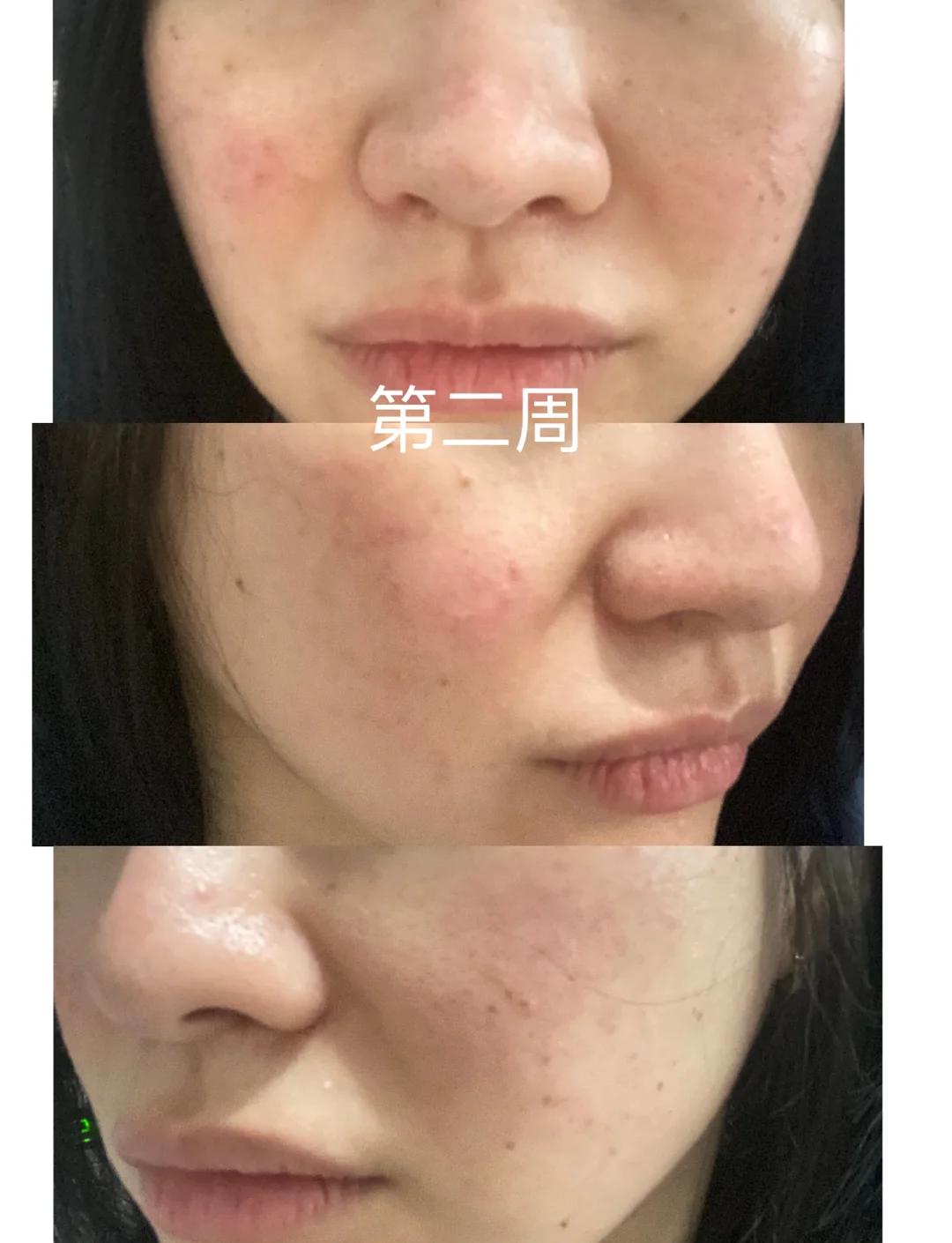 皮秒祛斑(皮秒祛斑后几天能掉痂,护理时要注意哪些事项?)