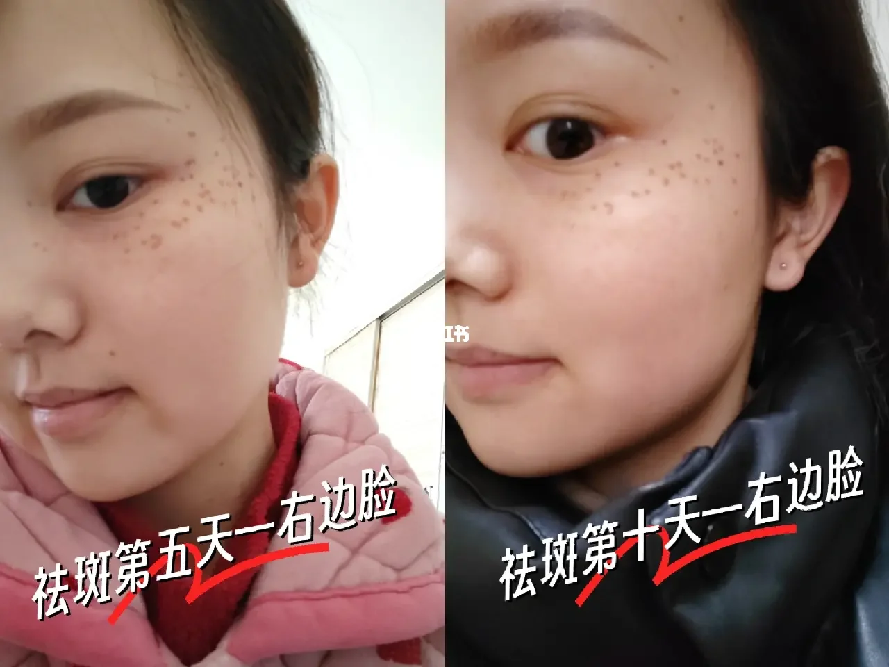 激光祛斑后几天可以洗脸(点阵激光祛斑后几天可以洗脸)