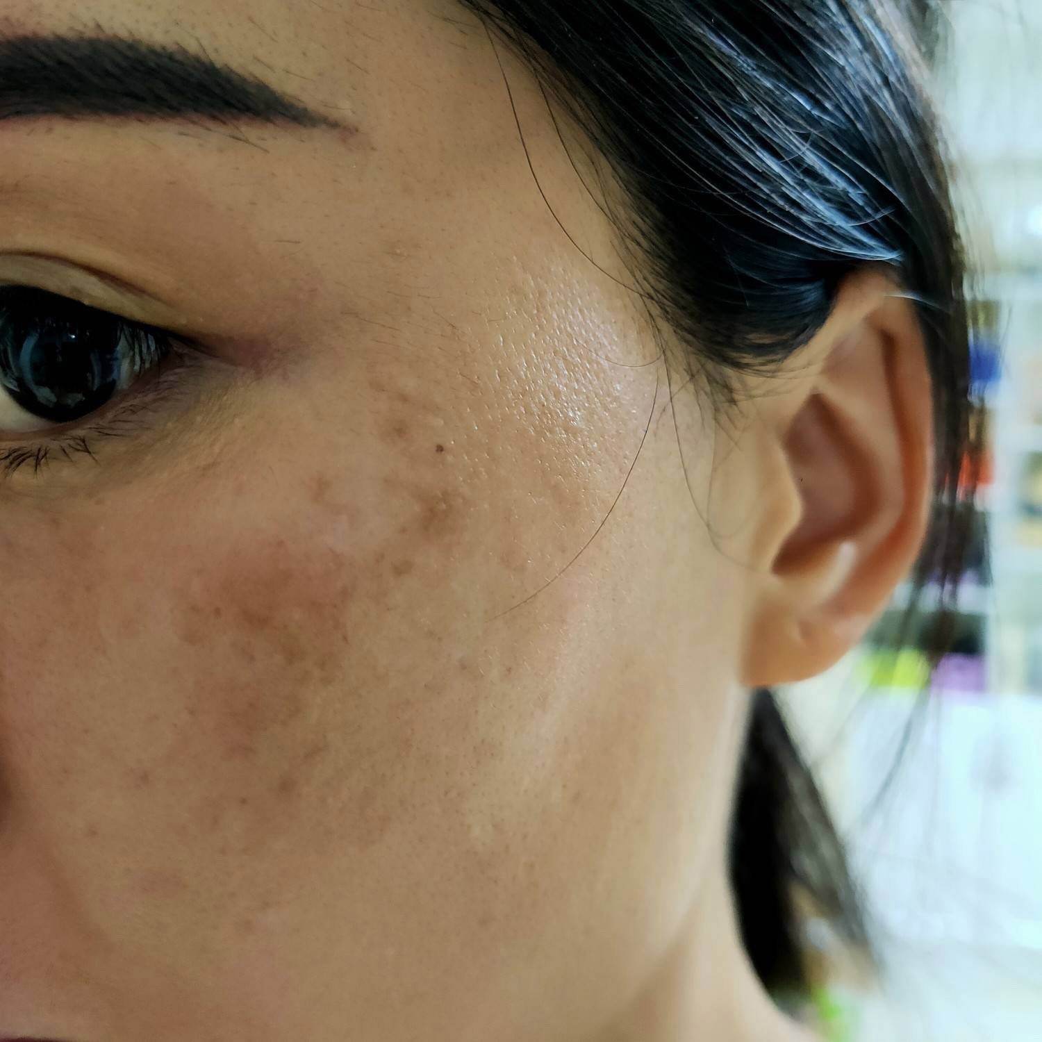 面部祛斑(面部祛斑后多久能恢复)