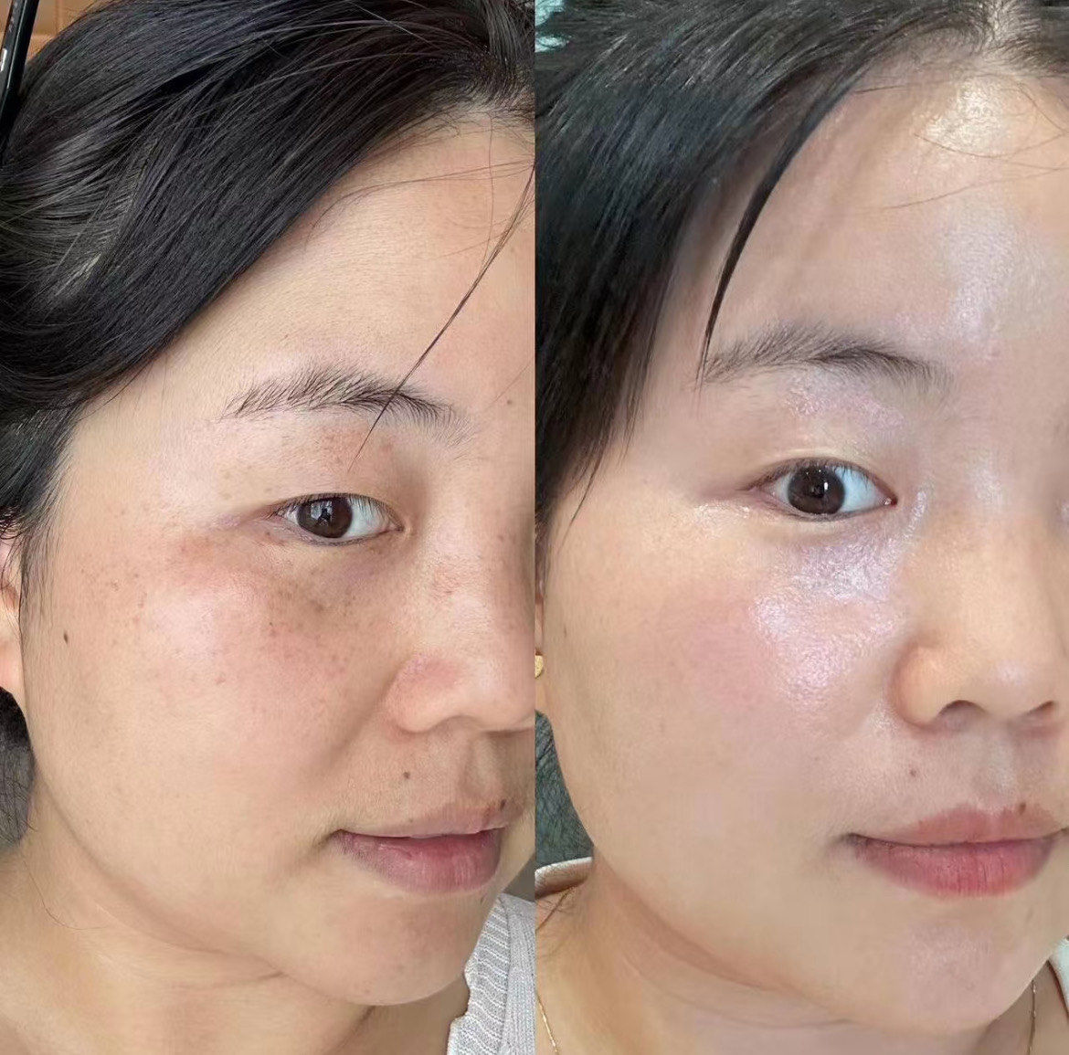 皮秒祛斑一次多少钱(皮秒祛斑10天变化图片)