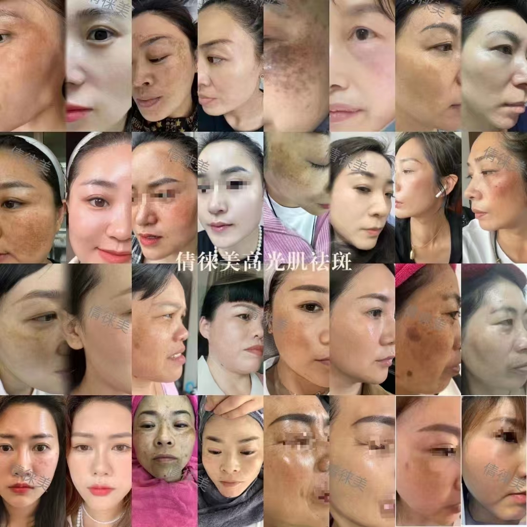 祛斑多少钱(祛斑多少钱一次?)