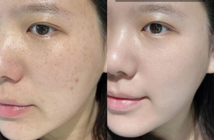 激光祛斑多少钱(c10激光祛斑多少钱)