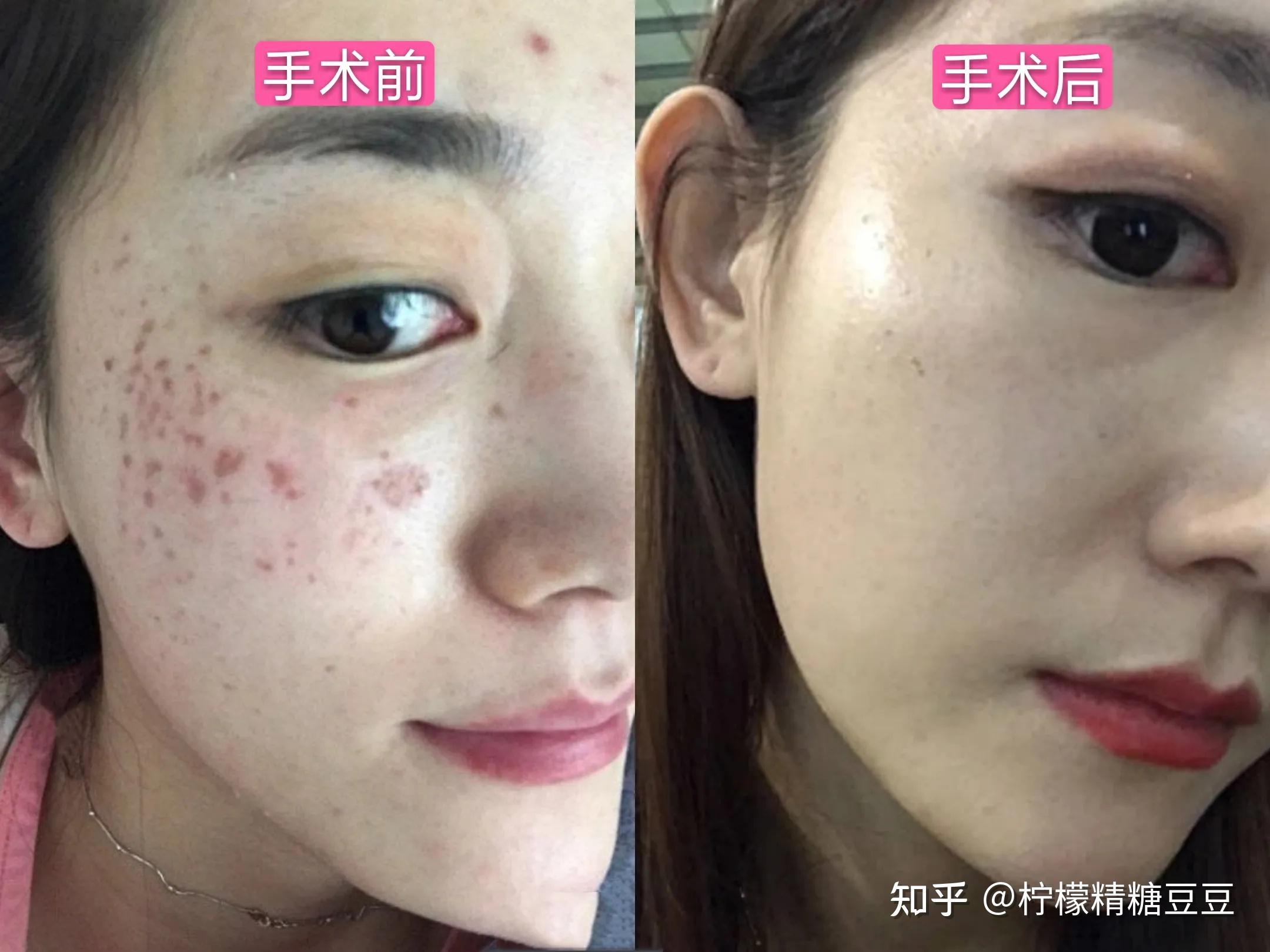 祛斑手术(祛斑手术费用大概多少钱)