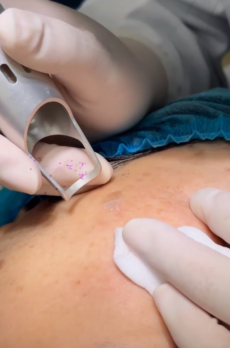 祛斑手术(祛斑手术费用大概多少钱)