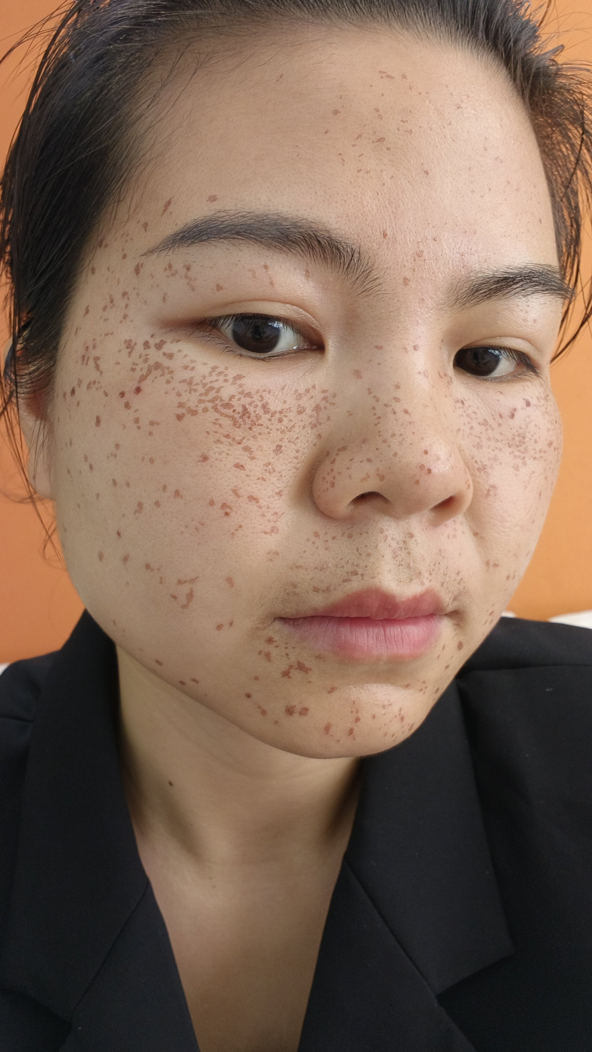 激光祛斑几天能恢复(正规医院祛斑大概要多少钱)