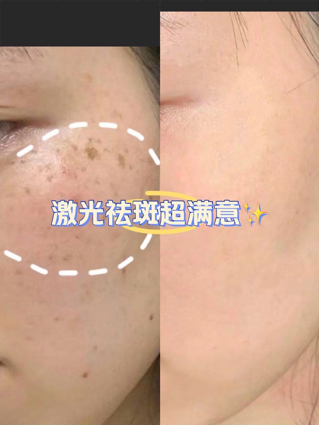 激光祛斑容易反弹吗(激光祛斑会不会反弹?)