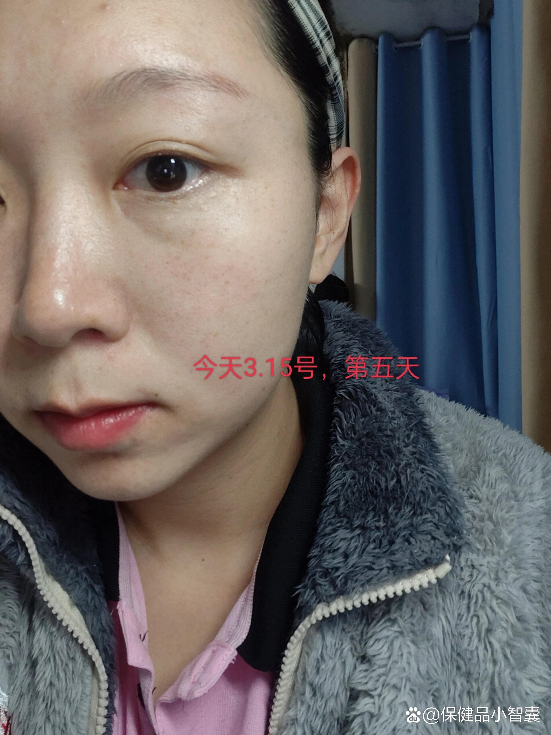 熊果苷祛斑有效果吗(熊果苷长期擦脸的危害)