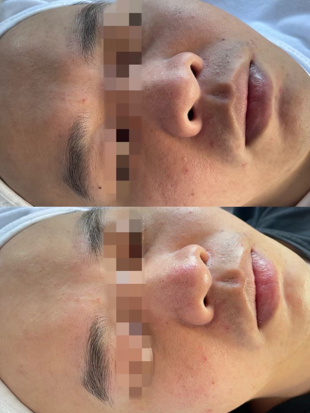 光子嫩肤祛斑效果怎么样(光子嫩肤和激光祛斑哪个更好)