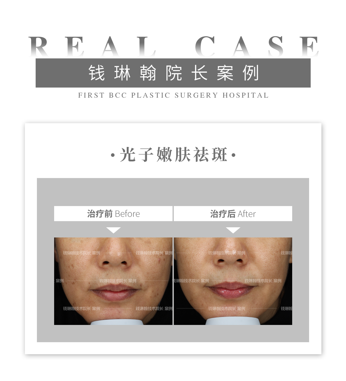 光子嫩肤祛斑效果怎么样(光子嫩肤和激光祛斑哪个更好)