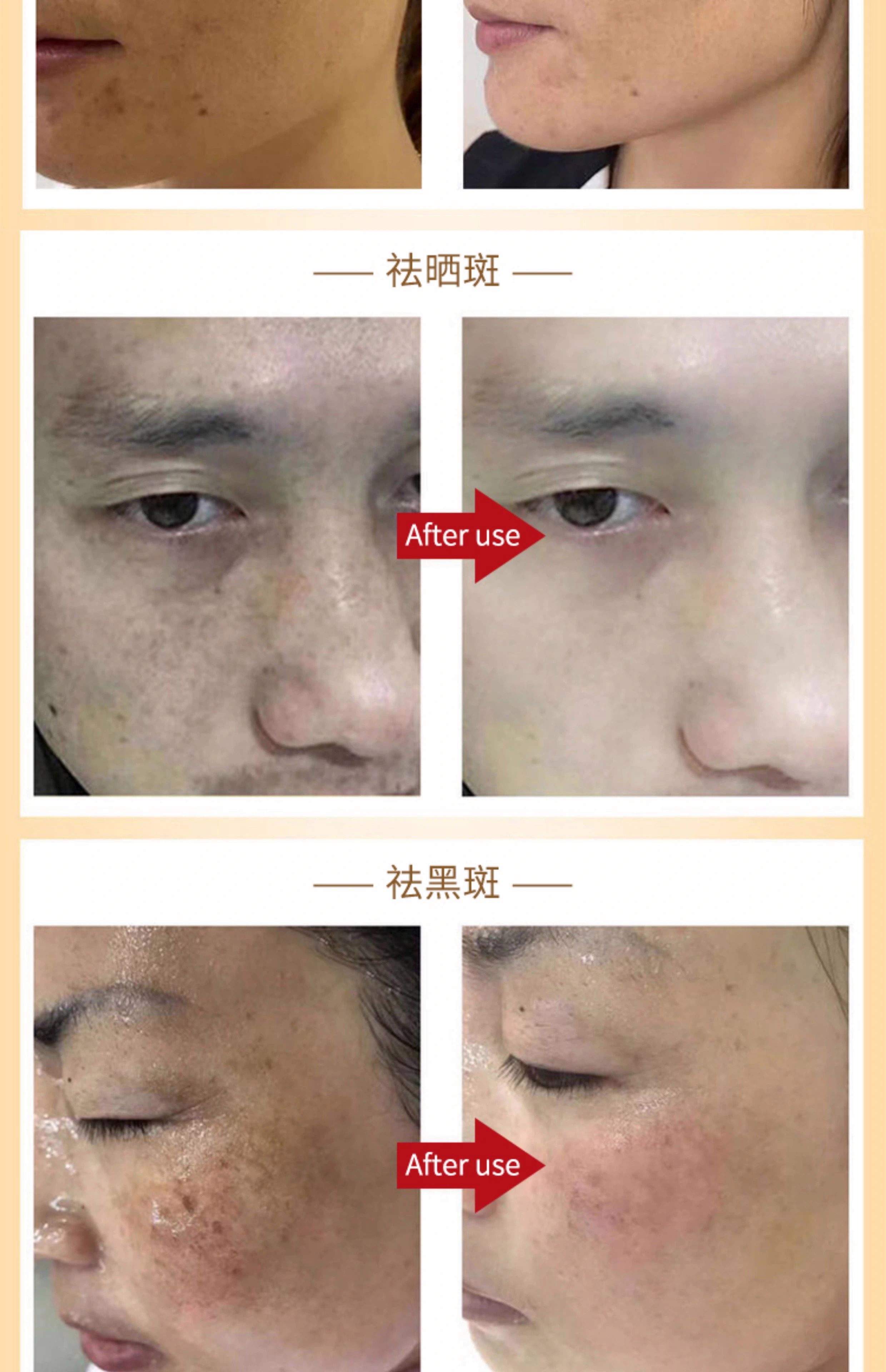 现在祛斑什么技术最好(现在祛斑什么技术最好用)