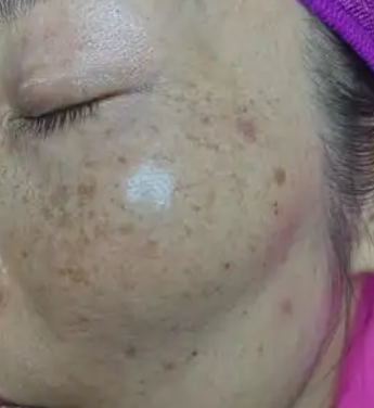 镭射祛斑效果及副作用(镭射祛斑效果及副作用图片)