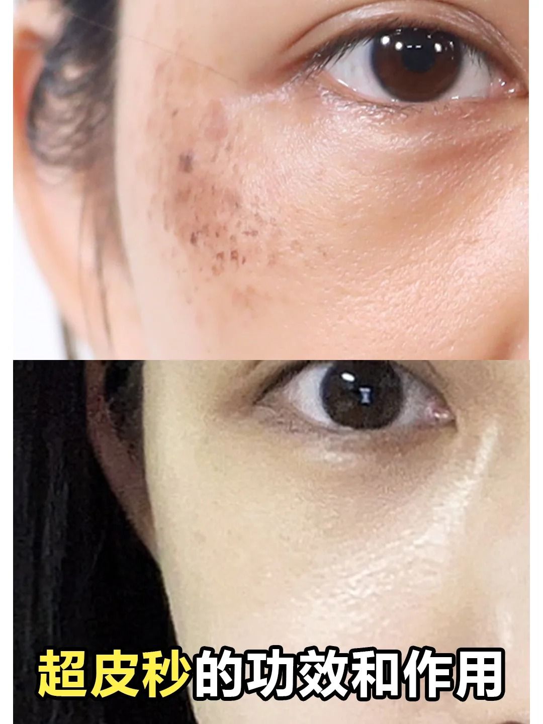 光子祛斑效果怎么样(光子嫩肤祛斑效果怎么样)