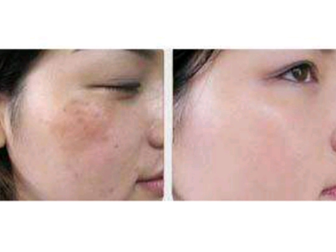 光子祛斑效果怎么样(光子嫩肤祛斑效果怎么样)