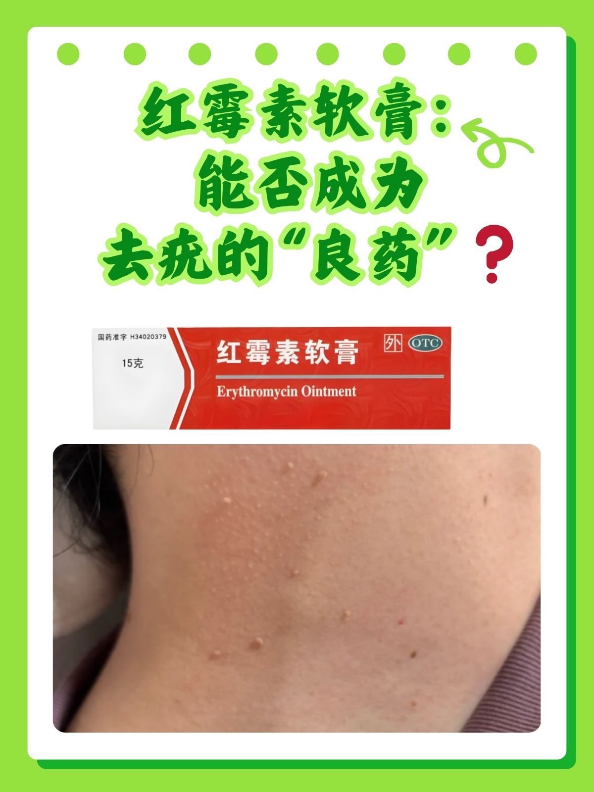 红霉素软膏可以祛斑吗(面霜加红霉素软膏可以祛斑吗)
