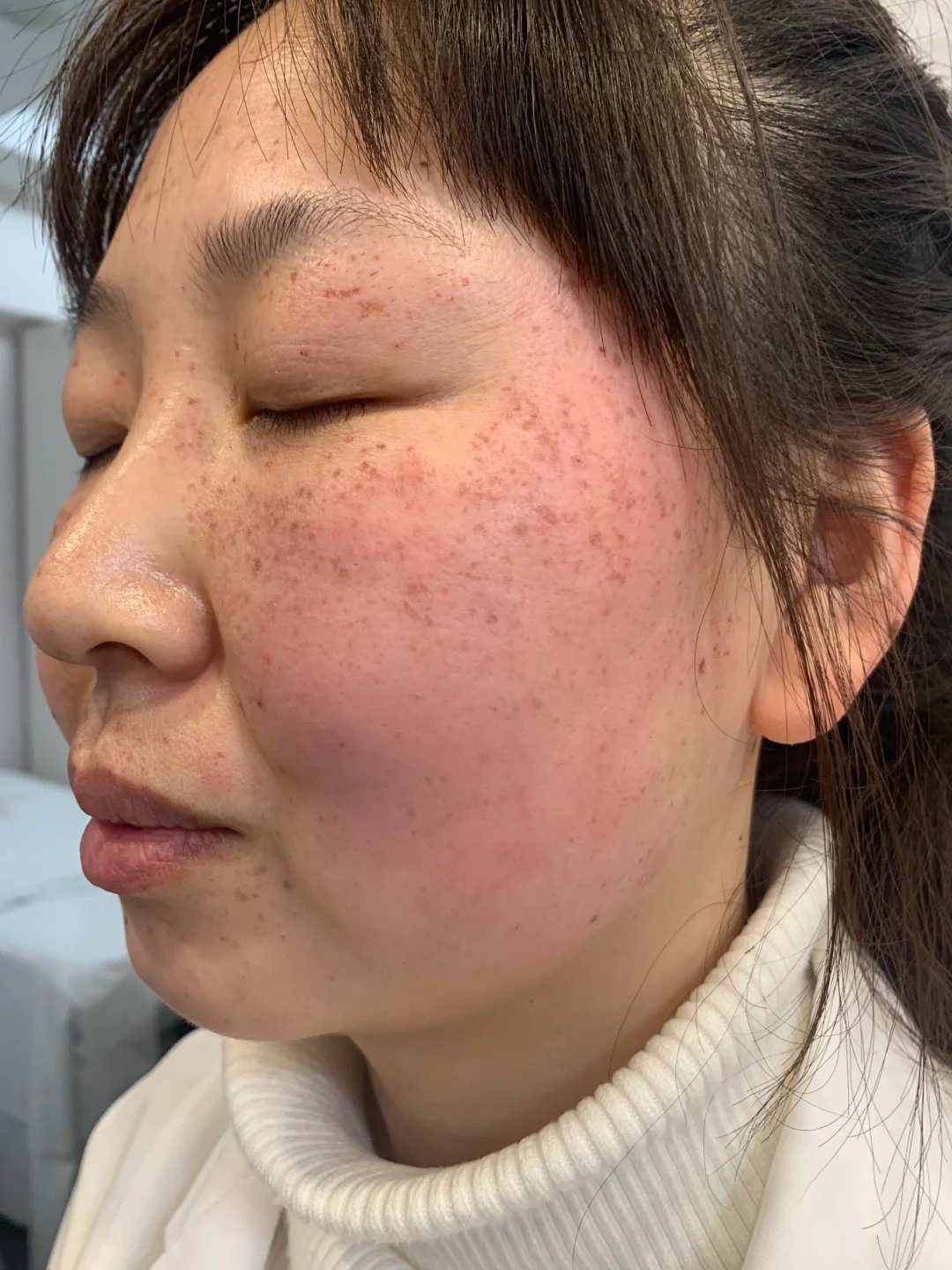 福州祛斑(福州祛斑华研专业)