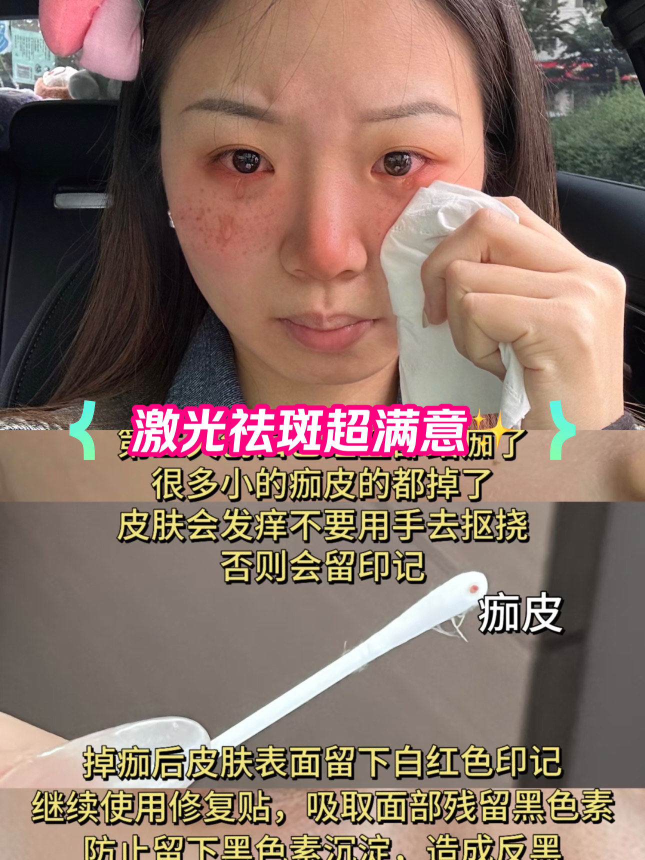 激光祛斑一次多少钱(激光祛斑一次多少钱能维持多久能彻底去掉吗)