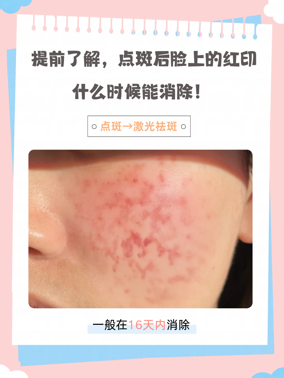 激光祛斑有效果吗(祛斑激光有副作用吗)