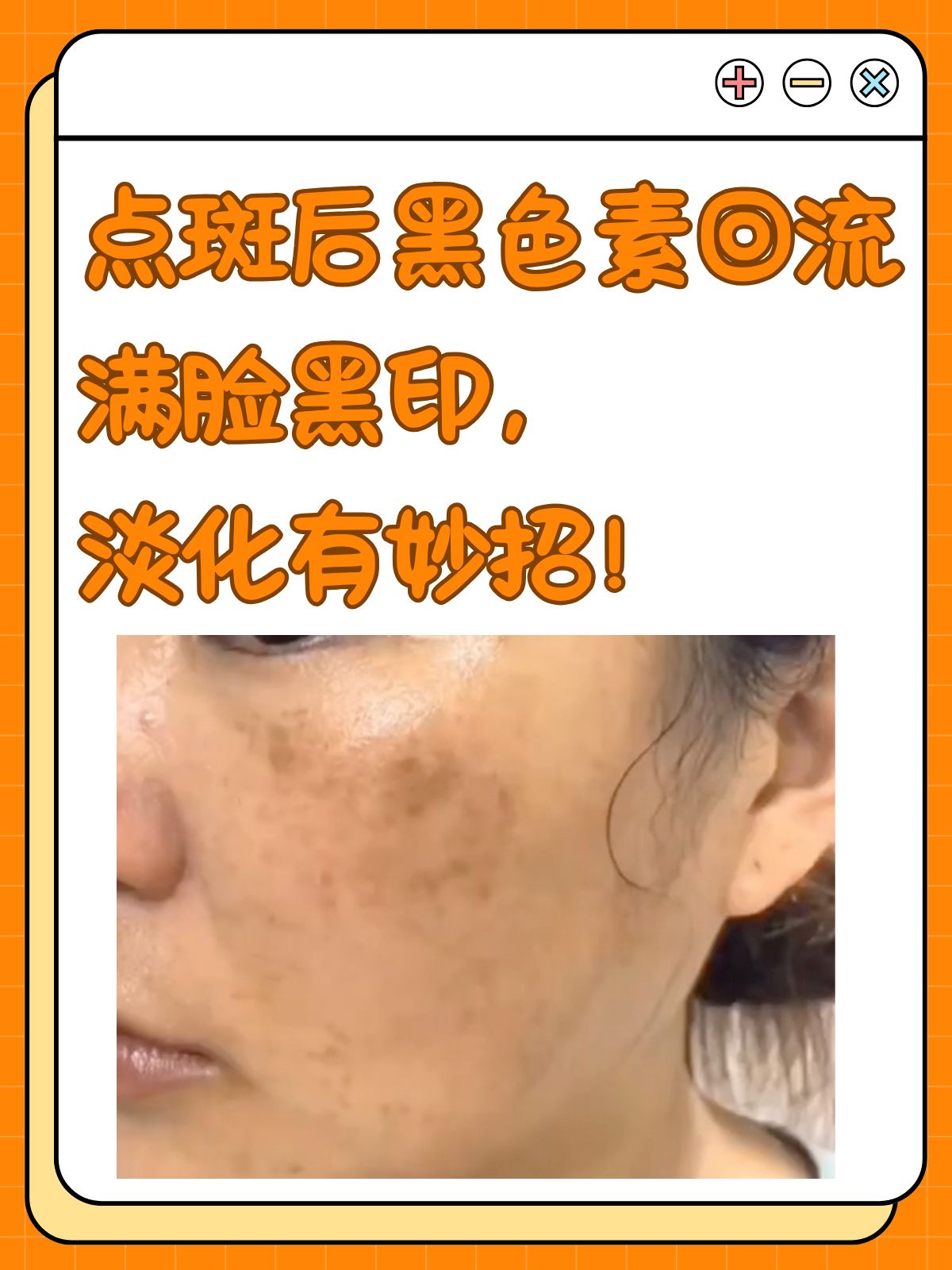 祛斑反黑期多久消失(祛斑反黑期是怎么回事)