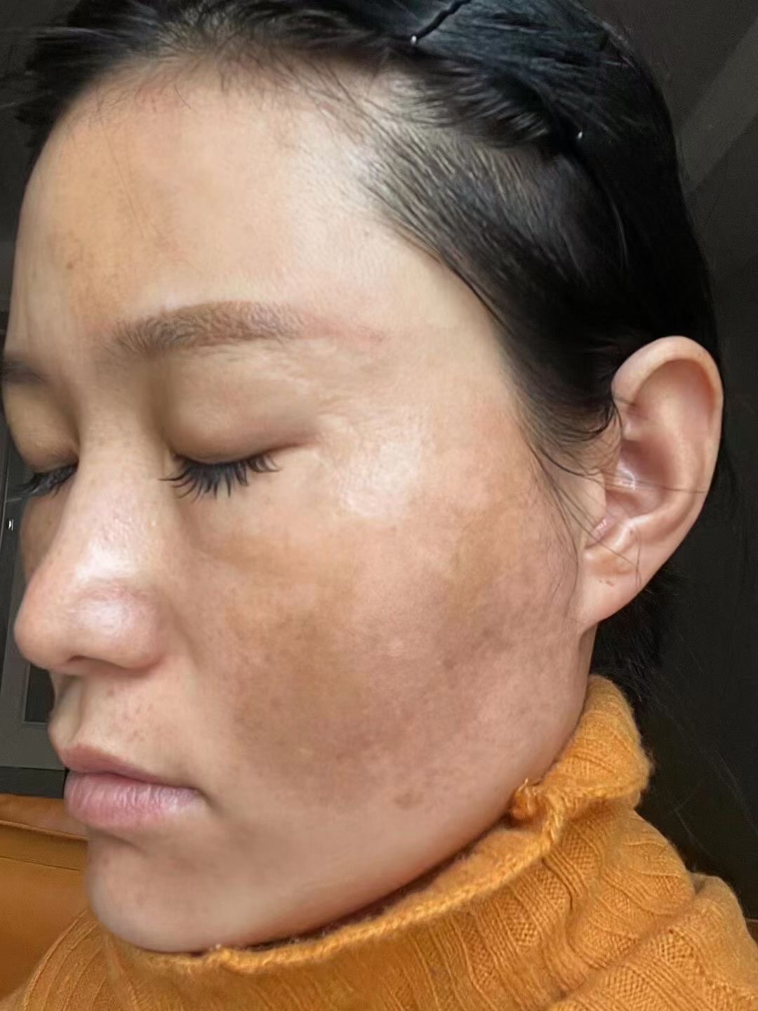 皮肤祛斑(皮肤祛斑脱皮后角质层受损多久可以恢复)