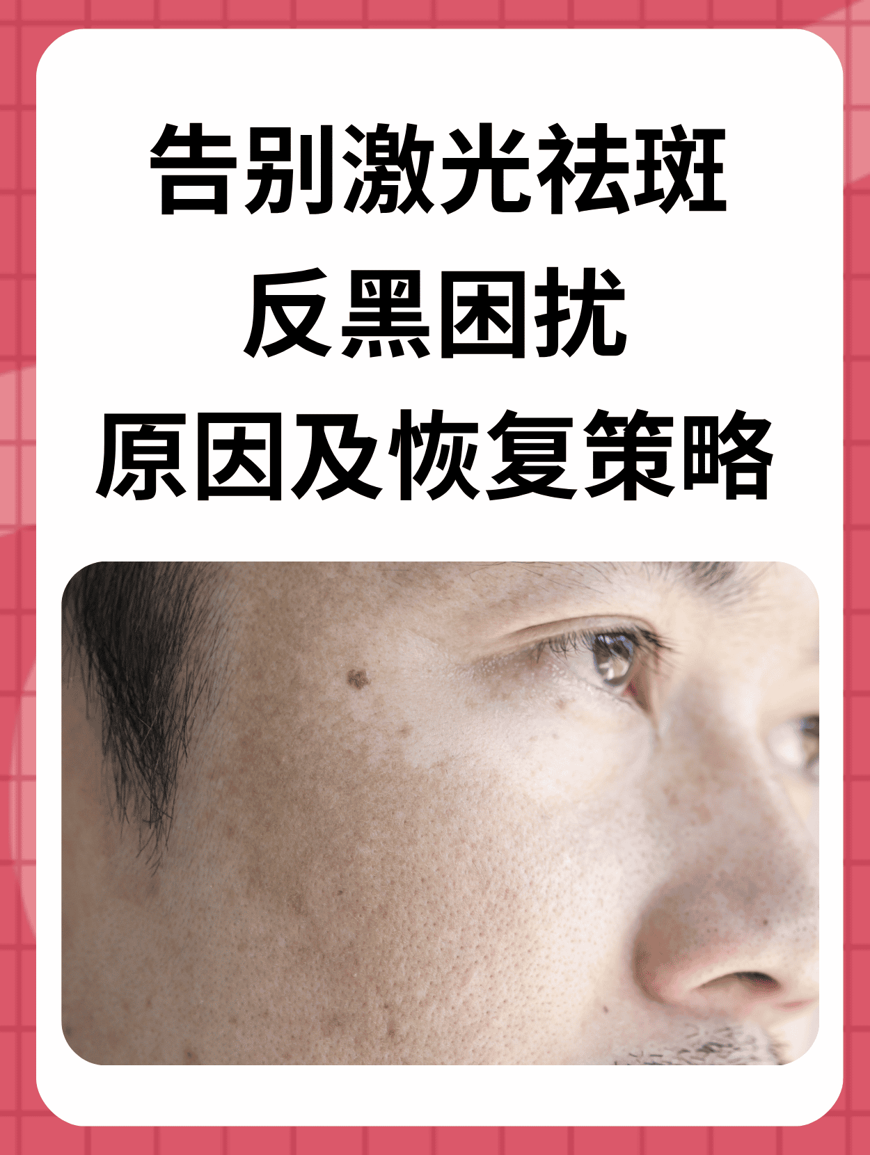 为什么明星不激光祛斑(激光祛斑20天变化图片)