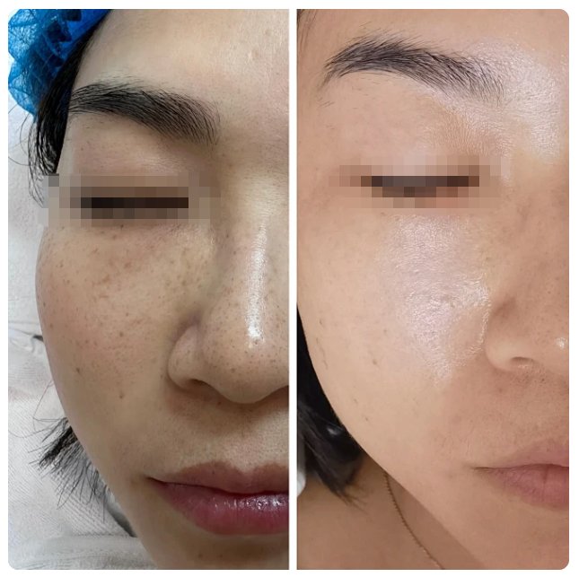 皮秒和激光哪个祛斑效果好(皮秒和激光哪个祛斑效果好一点)