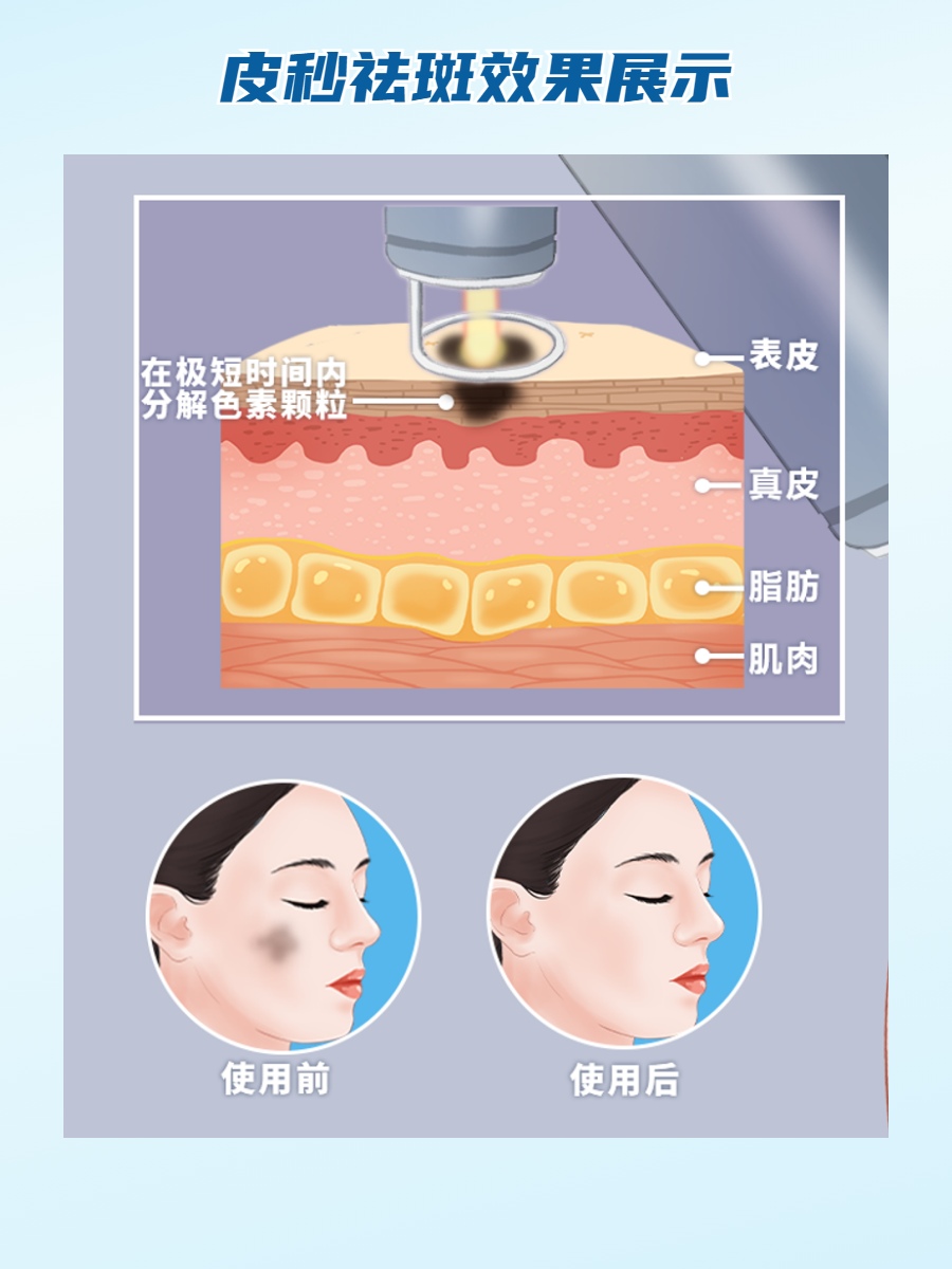 皮秒激光祛斑的弊端(皮秒祛斑的费用一般是多少)