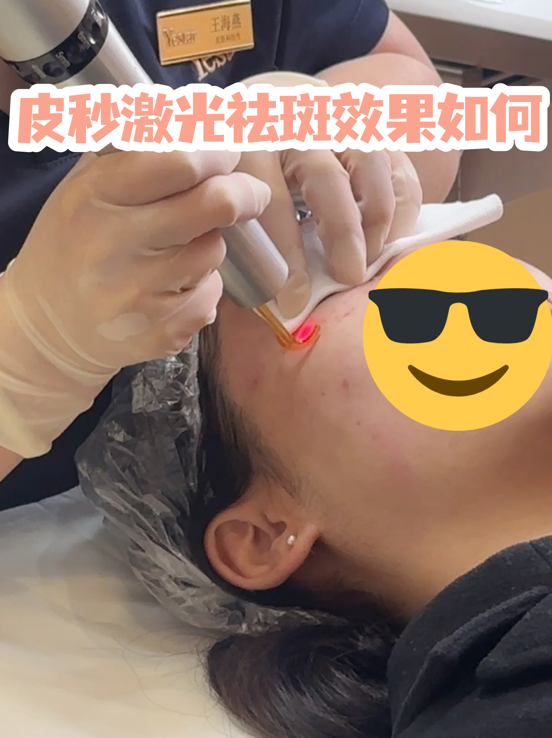 皮秒激光祛斑的弊端(皮秒祛斑的费用一般是多少)