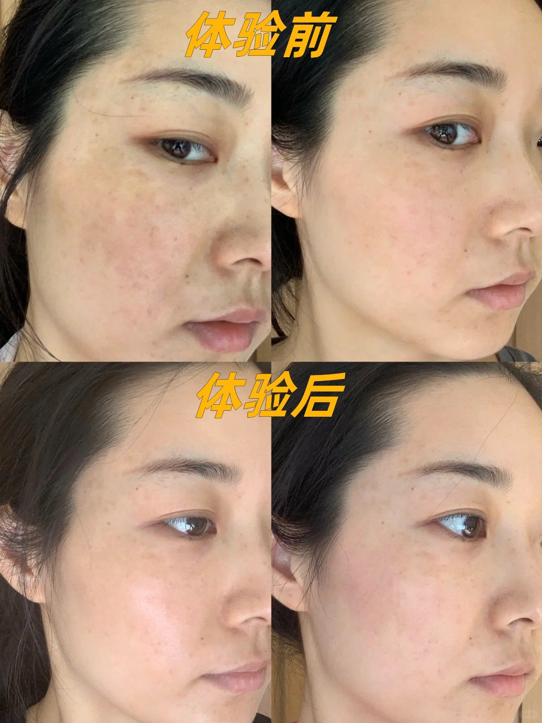 皮秒祛斑效果怎么样(秒皮祛斑怎么样会反弹吗)