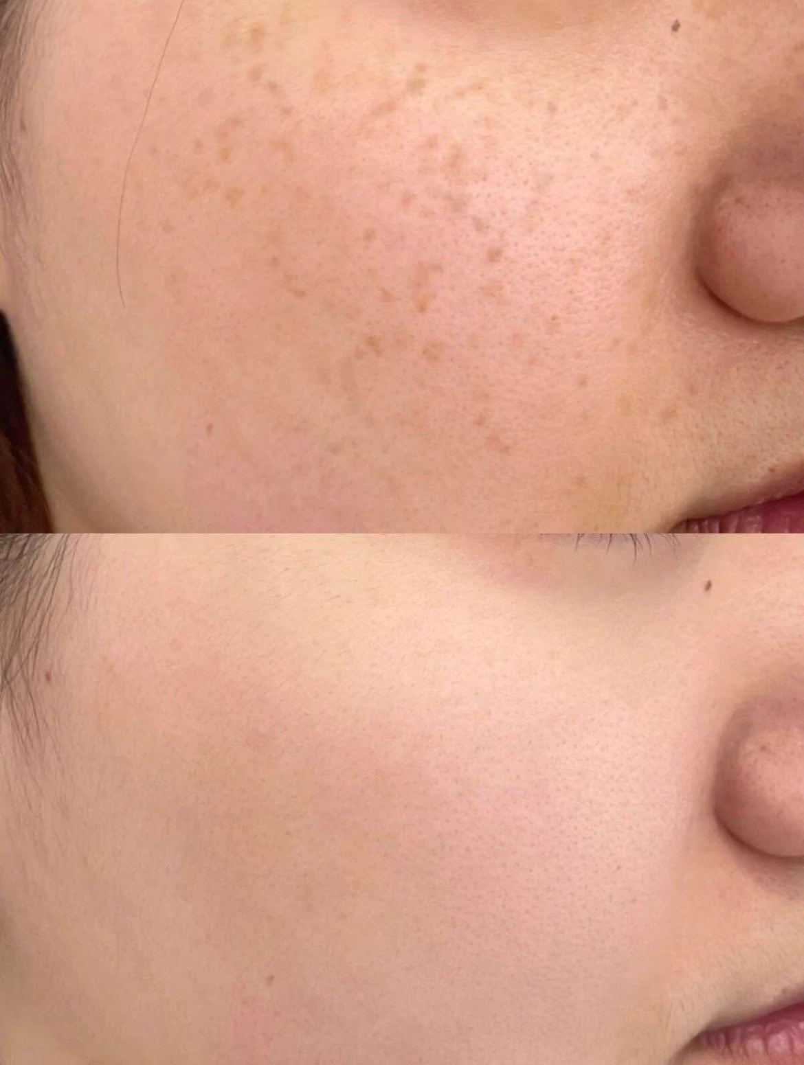 皮秒祛斑效果怎么样(秒皮祛斑怎么样会反弹吗)