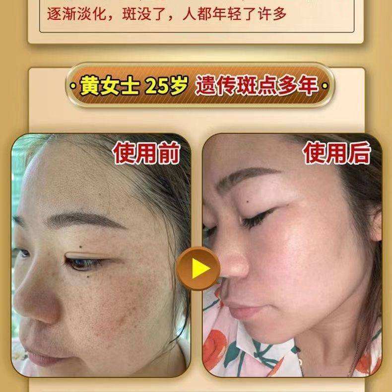 氢醌霜祛斑的危害(氢醌霜祛斑的危害有哪些)