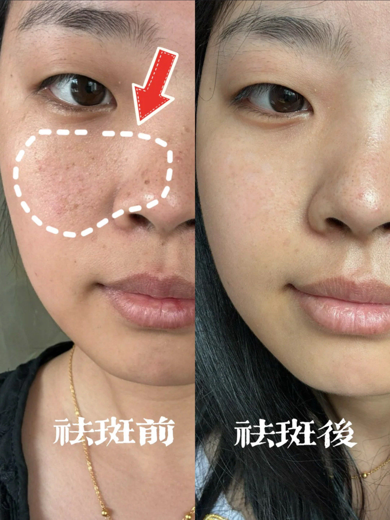 激光祛斑多久可以化妆(脸上的斑可以激光彻底去除吗)