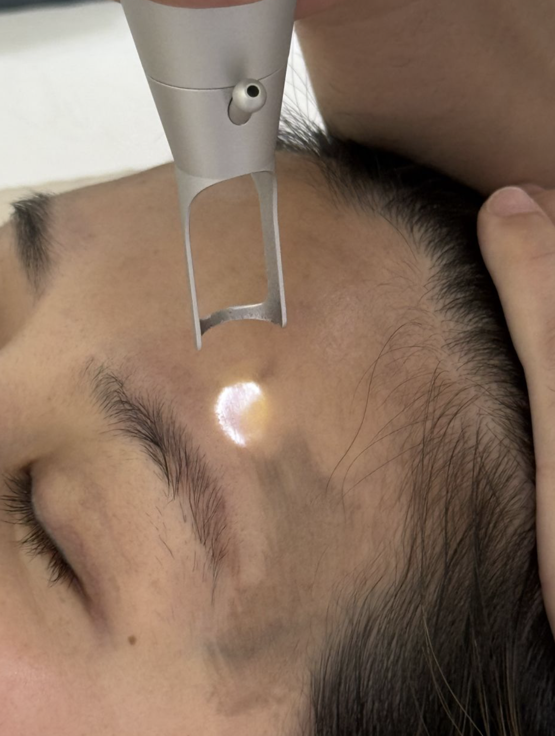 激光祛斑多久可以化妆(脸上的斑可以激光彻底去除吗)