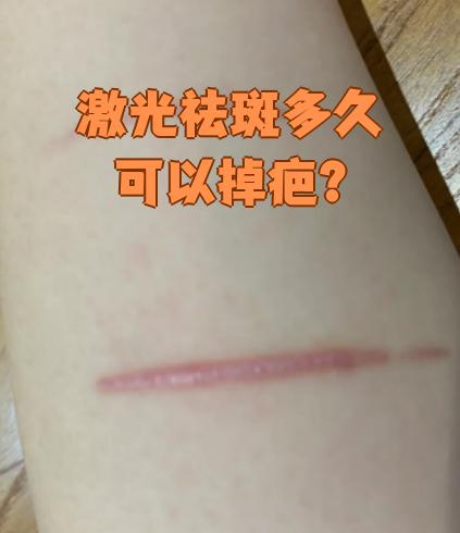 激光祛斑会留疤吗(激光祛斑会不会留疤或者有坑)