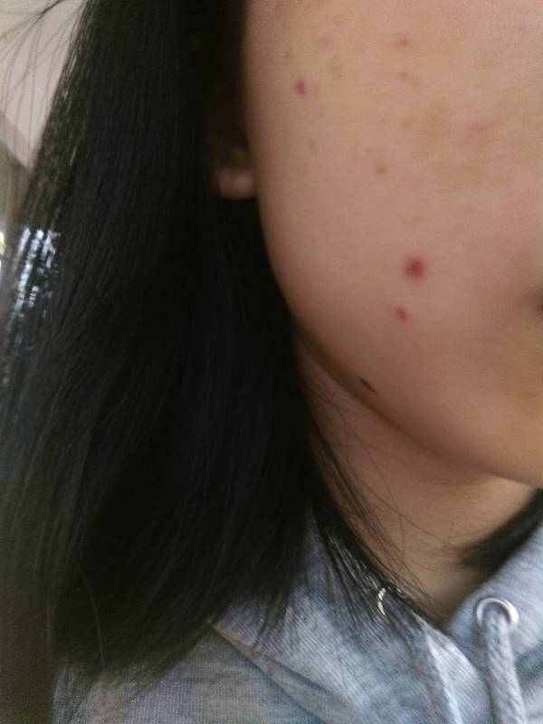 激光祛斑会留疤吗(激光祛斑会不会留疤或者有坑)