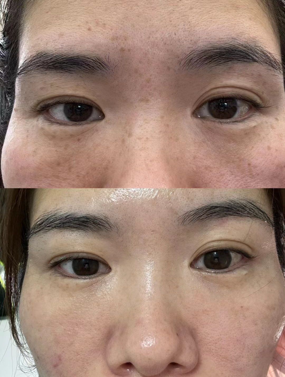 皮秒激光祛斑(皮秒激光祛斑的危害)