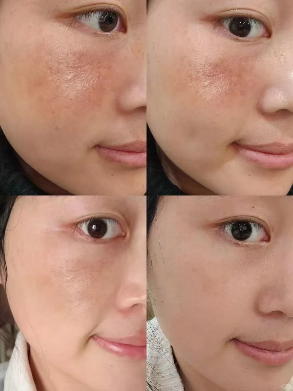 皮秒激光祛斑(皮秒激光祛斑的危害)