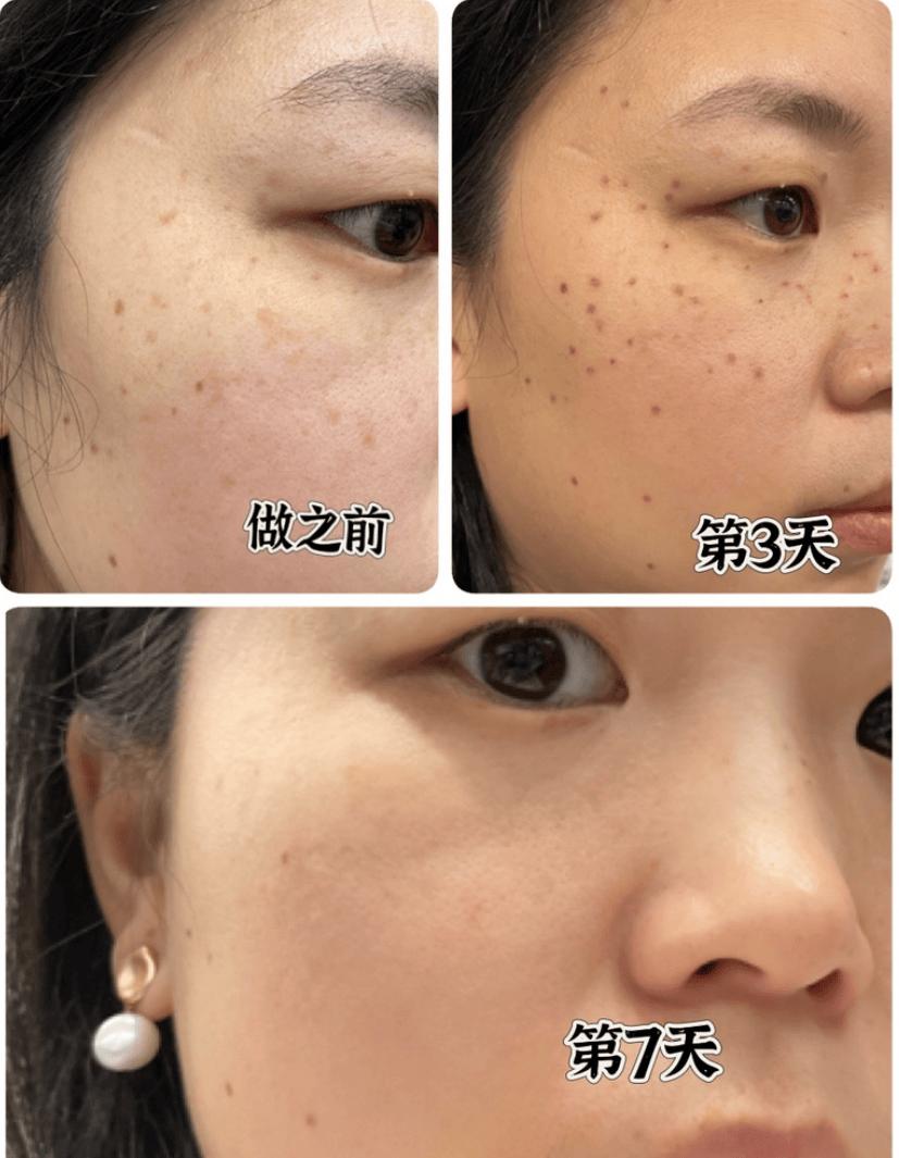 祛斑最好的方法(祛斑最好的方法是激光祛斑吗)