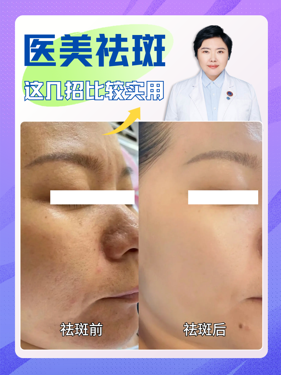 医美祛斑(医美祛斑真的能去掉吗)