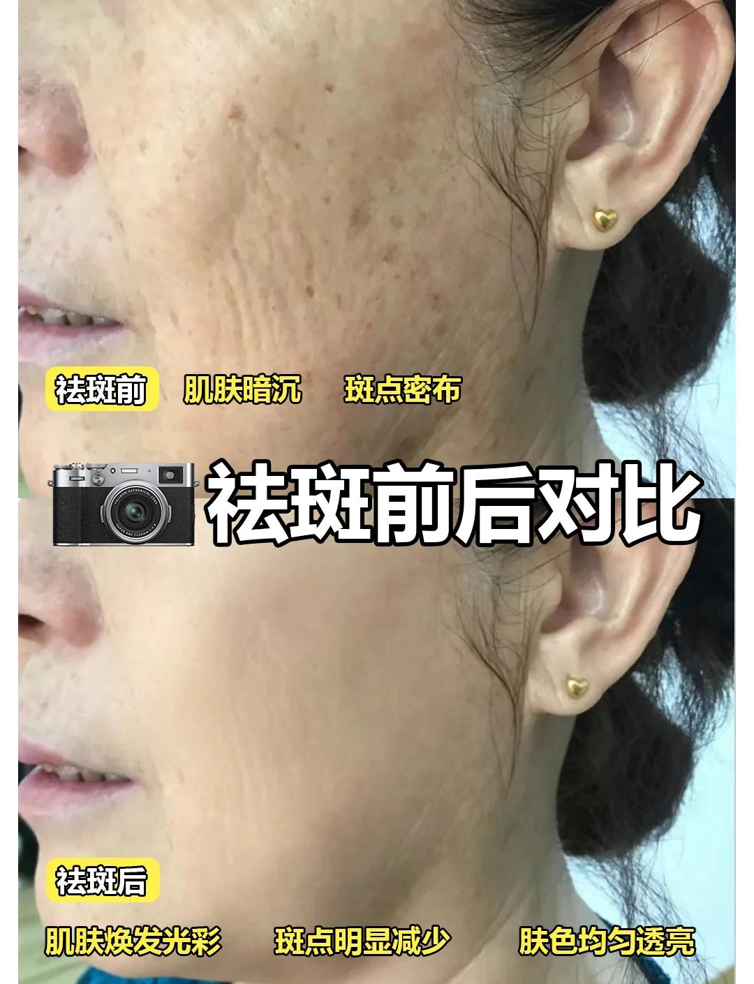 祛老年斑小妙招(祛老年斑小妙招图片)