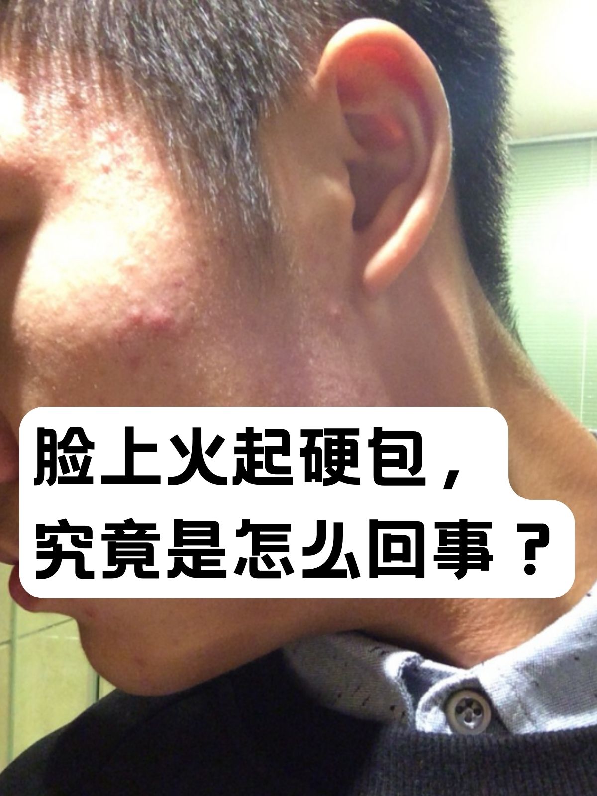 脸上长痘痘红肿硬块摸起来很疼(脸上长痘痘红肿硬块用什么药膏)