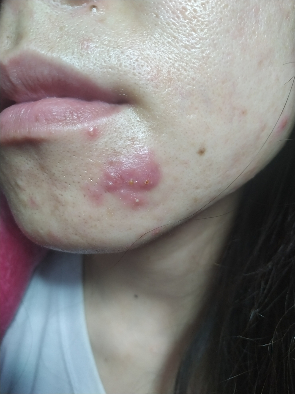 脸上长痘痘红肿硬块摸起来很疼(脸上长痘痘红肿硬块用什么药膏)