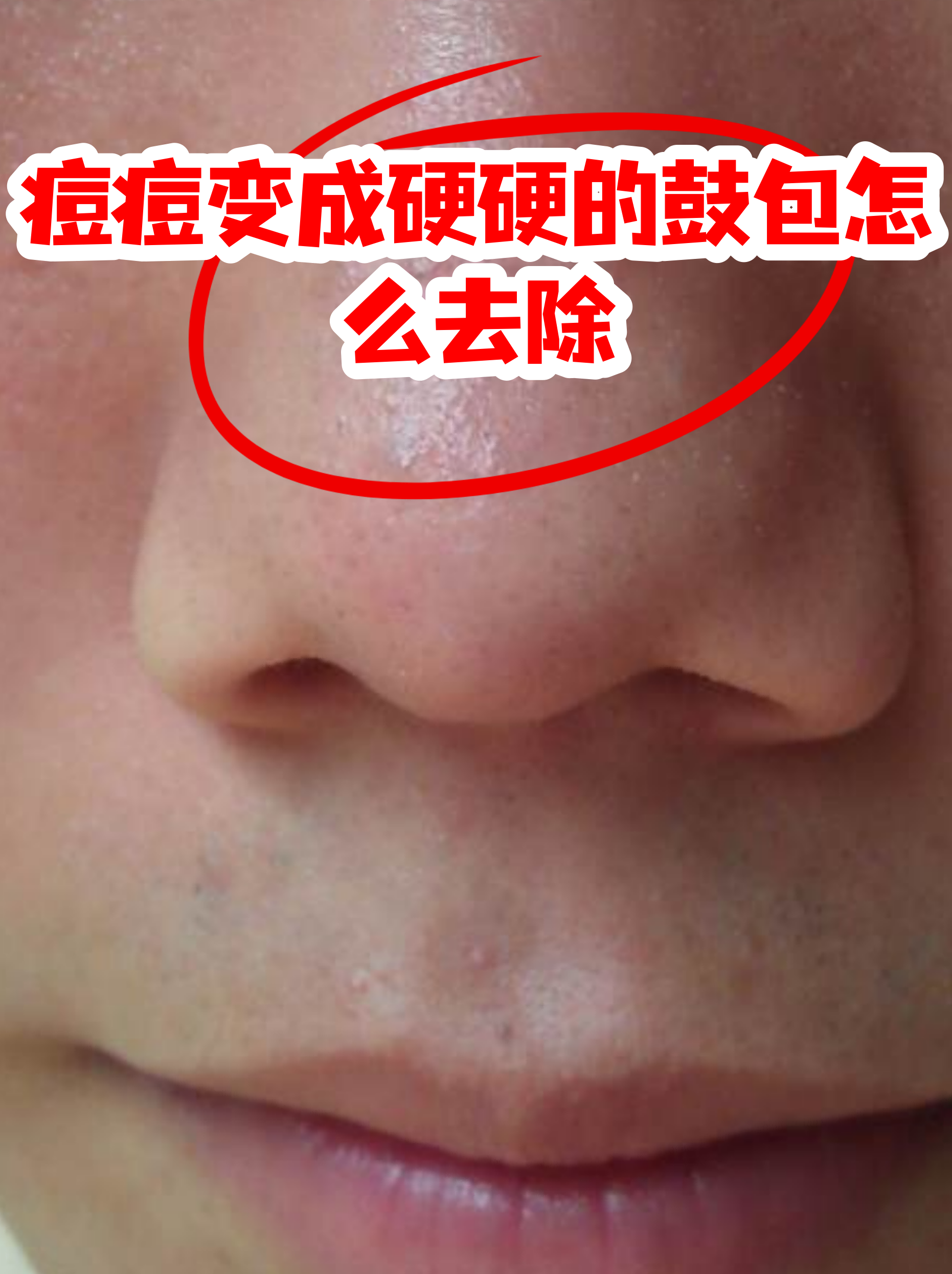 硬块痘痘怎么快速消除(硬块痘痘怎么快速消除不疼)