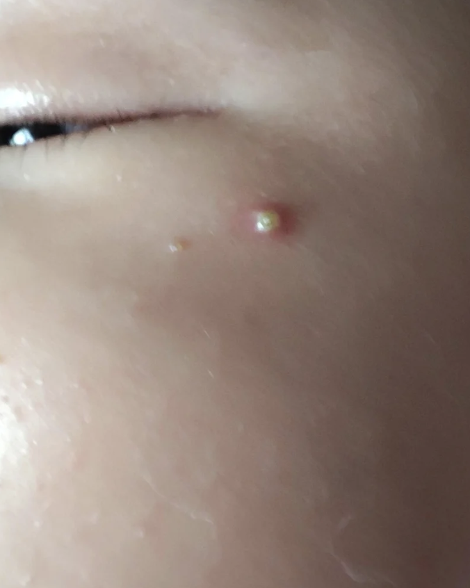 脸上起脓包痘痘怎么办(脸上起脓包痘痘怎么回事)